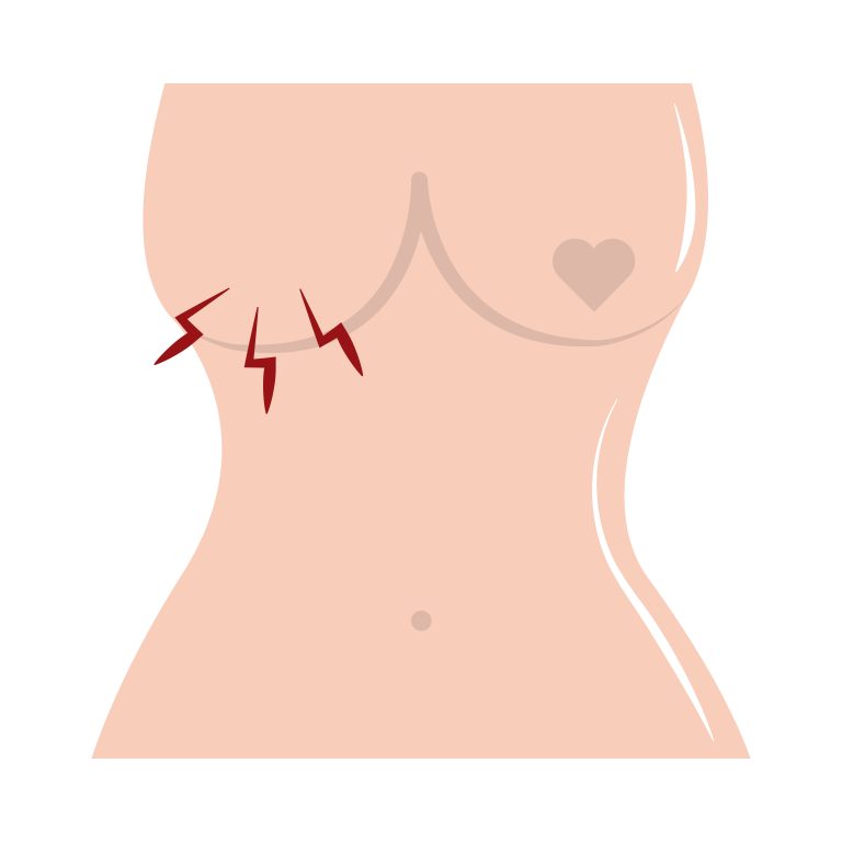 Read more about the article Breast Lumps