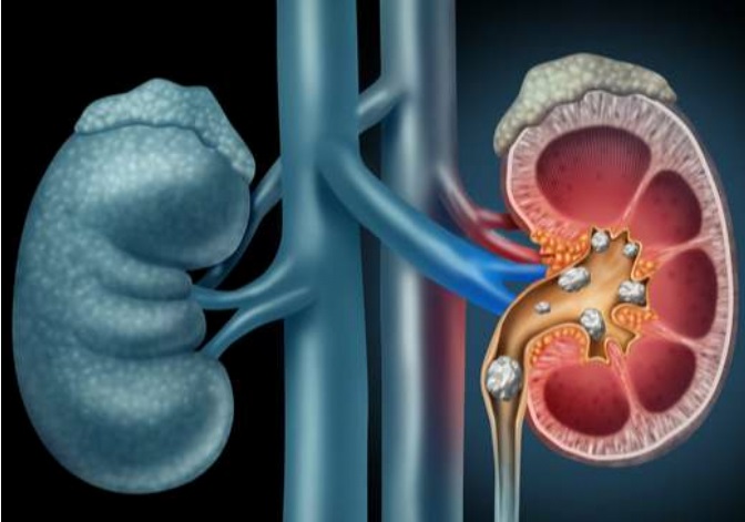 Read more about the article Kidney Disorders