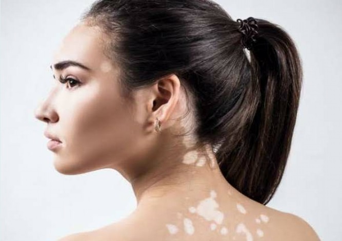 Read more about the article Skin Disorders