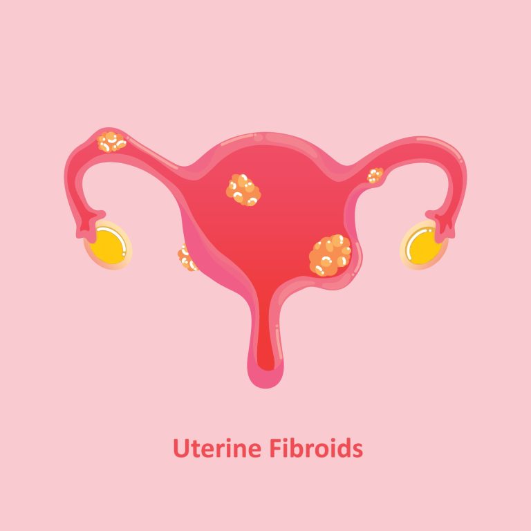 Read more about the article Uterine Fibroids