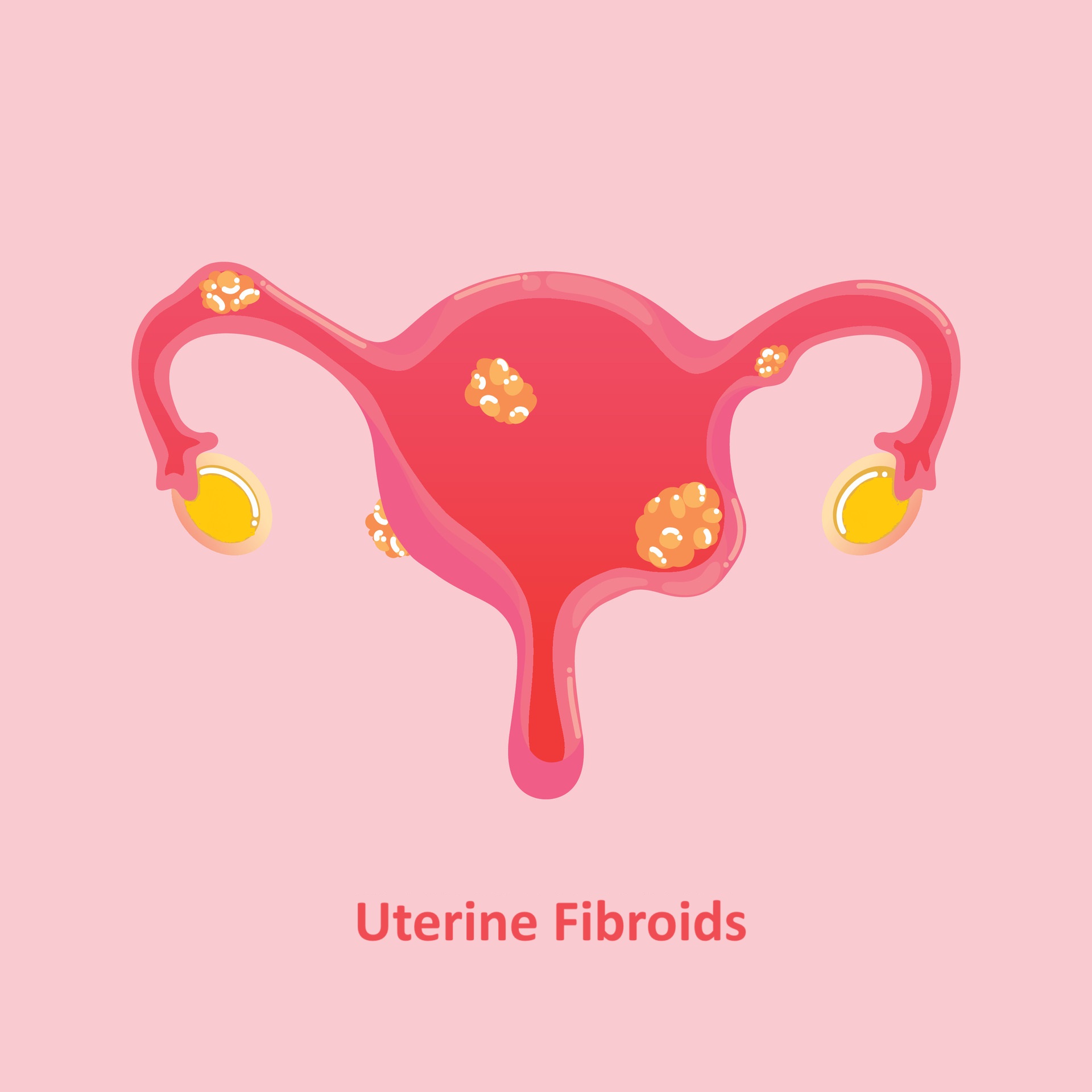 You are currently viewing Uterine Fibroids